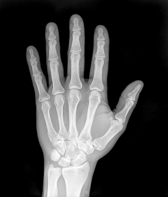 X-Ray of a hand